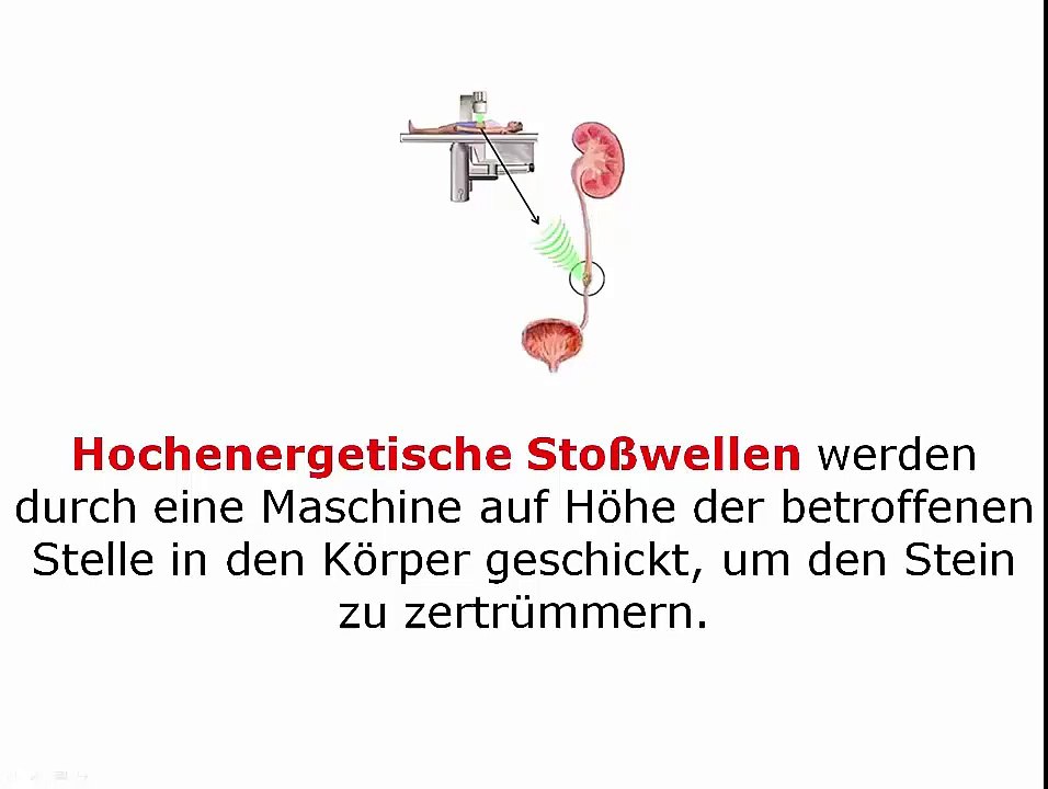 Nierensteine entfernen ohne OP - SCHNELL und SCHMERZFREI