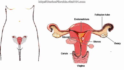 Fibroids During Pregnancy Home Remedies - Natural Treatment For Uterine Fibroids