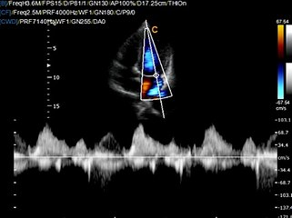 Chison Q5 Cardiac CW Continues Wave most affordable eCo cardiac Ultrasound
