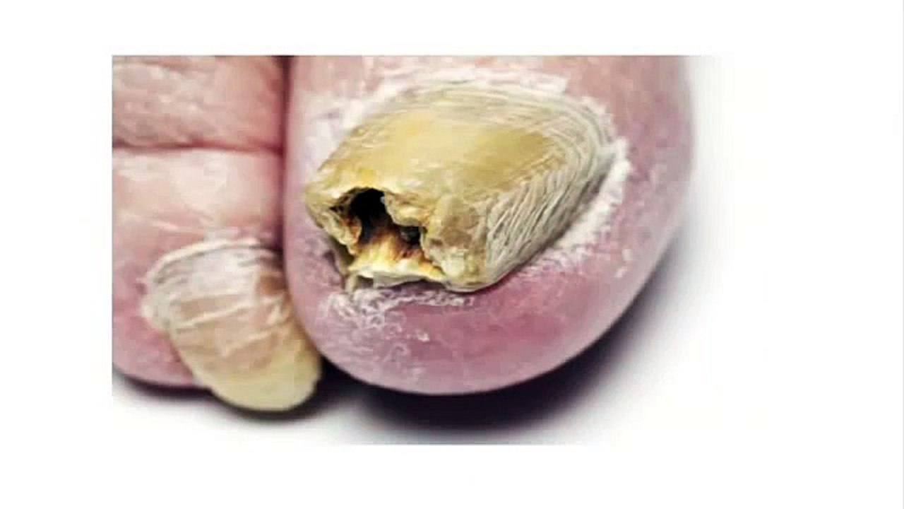 Treat Nail Fungus - Best at Home Toenail Fungus Treatments