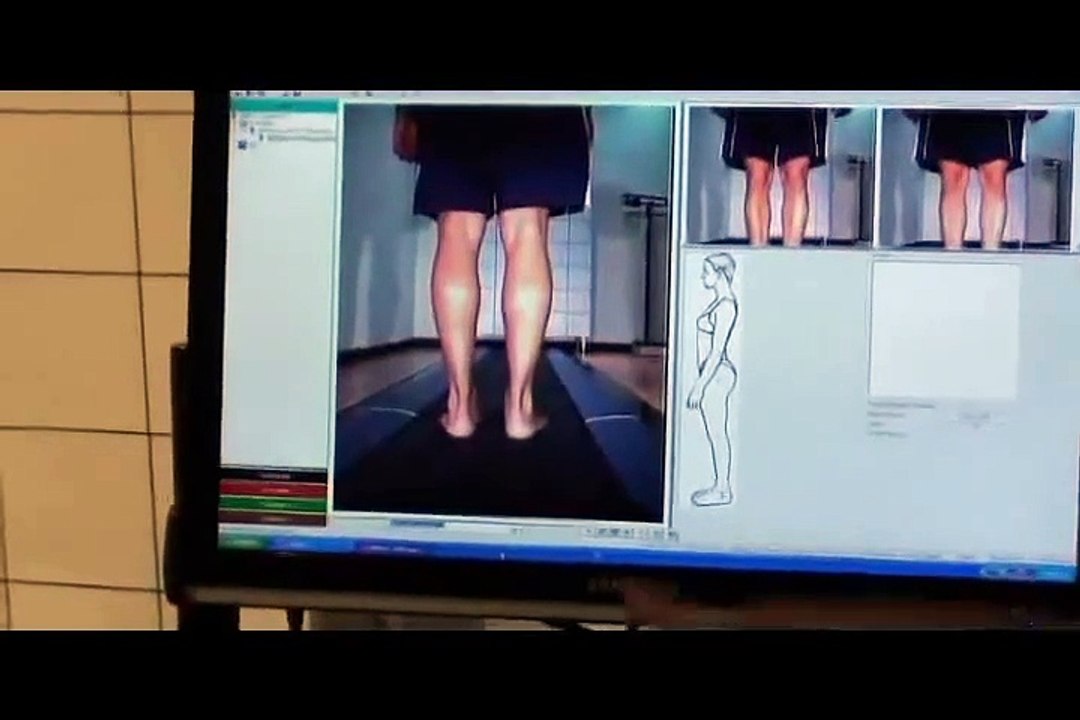 Baropodometría y plantillas ortopédicas personalizadas