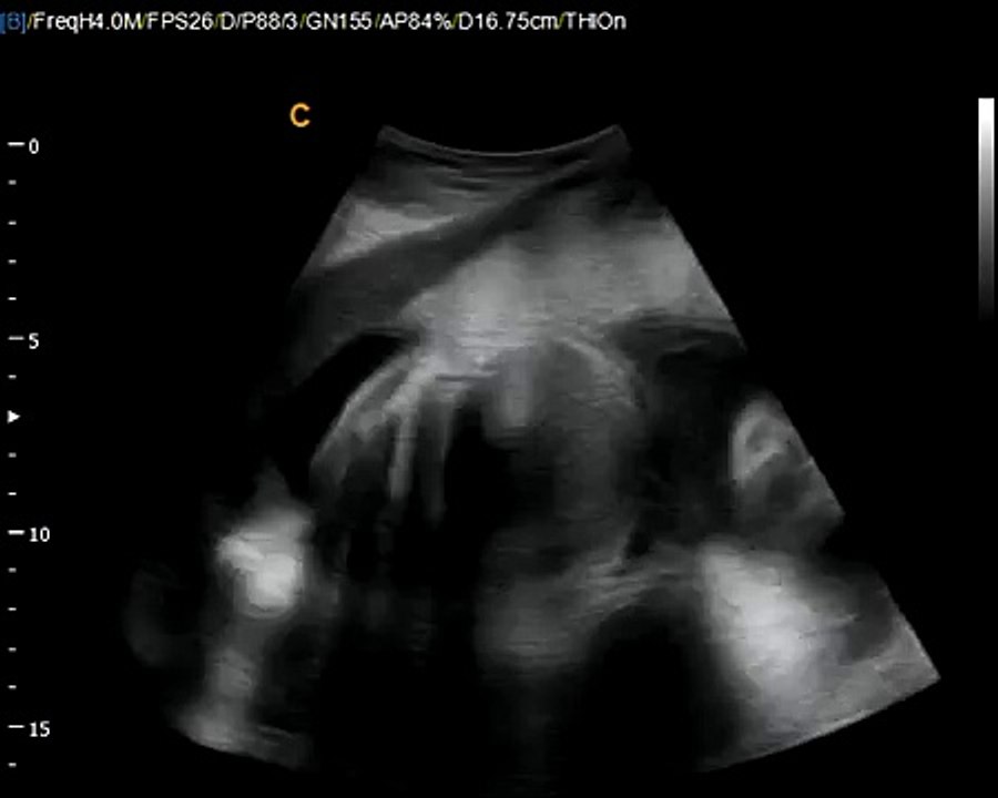 Chison Q5 Fetal Ultrasound -Lowest price of Color Doppler ultrasound