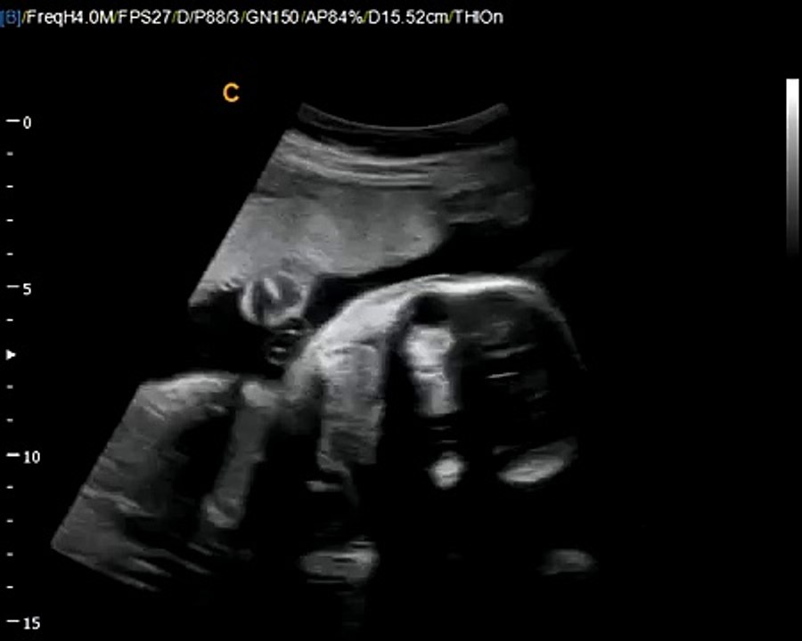 Best Deal on Fetal, neonatal Ultrasound machine-Chison Q5 Fetal Sonogram