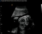 Q5 by Chison imaging Fetal Heart sonogram, easy to see heart in fetus, neonatal ultrasound