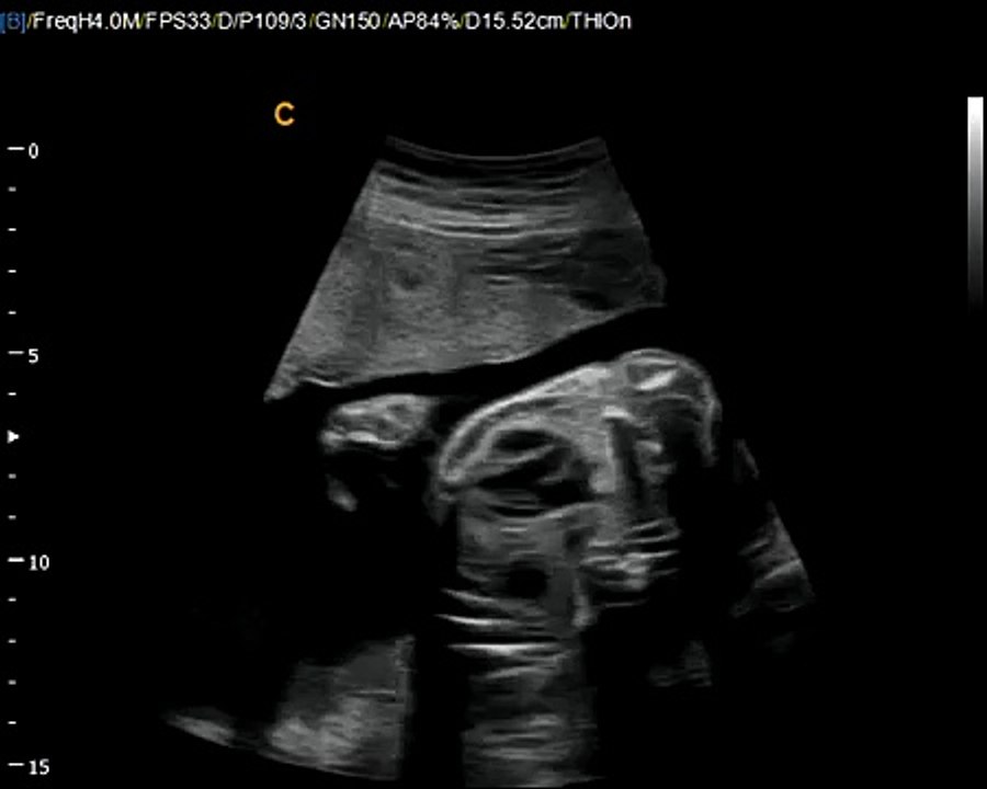 Q5 by Chison imaging Fetal Heart sonogram, easy to see heart in fetus, neonatal ultrasound