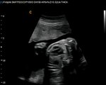 Q5 by Chison  imaging Fetal Heart sonogram , easy to see heart in fetus, neonatal ultrasound