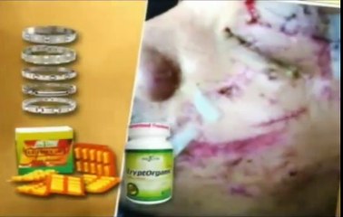 Kryptorganic, Ultima-C, Bio-magnetic Bracelet - Cure for Severe Damage of Skin Tissues Testimonial