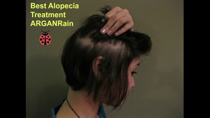 Argan Rain is the Best Treatment for Alopecia (Hair Loss)
