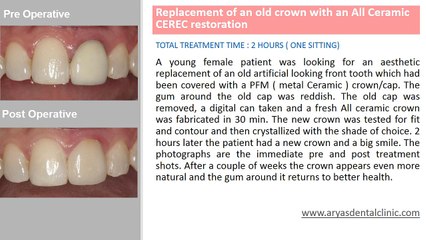 Full Mouth Dental Implant Supported Fixed Teeth