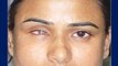 Artificial Eye Fitting (False Eye Ocular Prosthesis) Prosthetic Eye Fitting Surgery in Mumbai,India