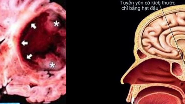 Ung thu nao - By Benh Vien Ung Buou Hung Viet