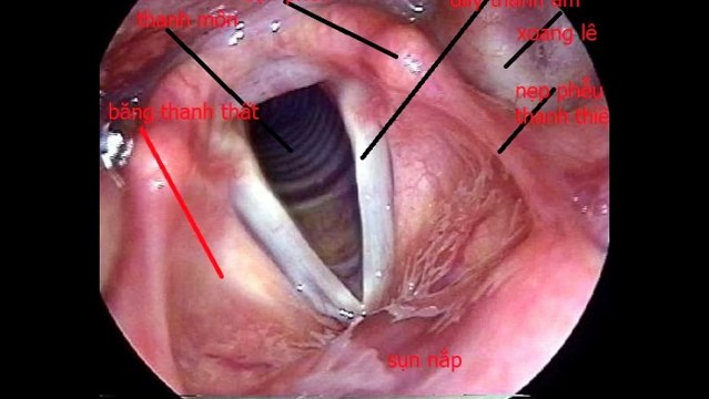 Ung thu thanh quan - By Benh Vien Ung Buou Hung Viet