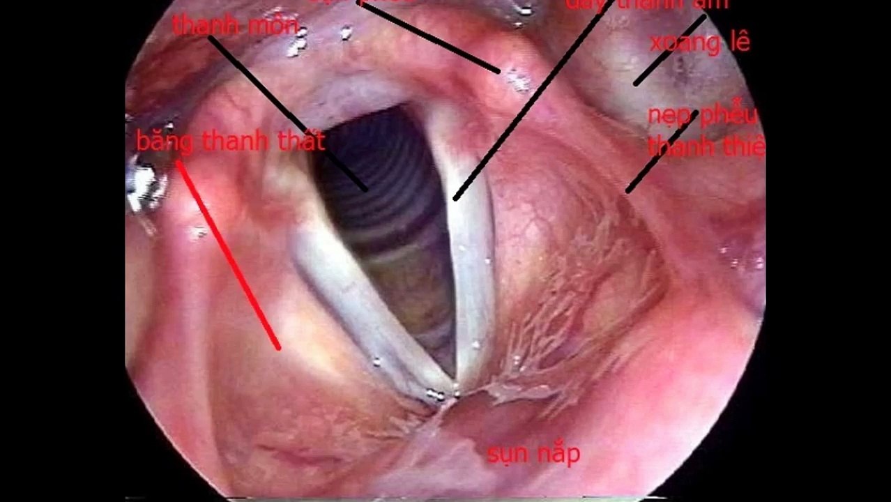 Ung thu thanh quan - By Benh Vien Ung Buou Hung Viet