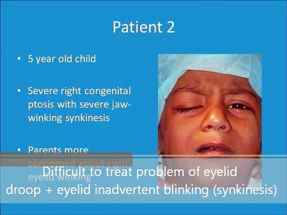 Best Child Droopy Eyes Surgery  Congenital Ptosis Eyelid Treatment in Mumbai, India