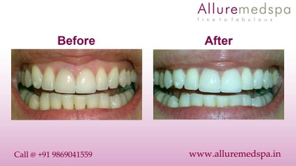 Gum Striping Treatment in Andheri