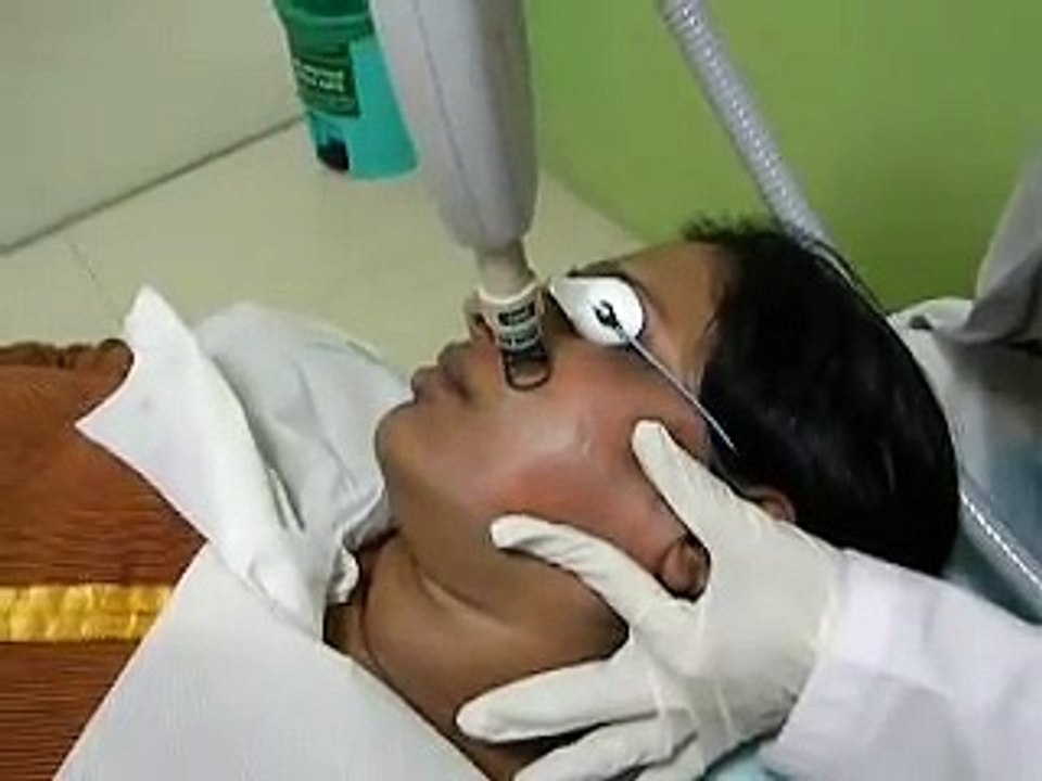 Fractional Erbium YAG Laser Acne Scars Treatment in Mumbai, India Dr Rinky Kapoor video
