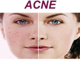 Jugos para el acné (Remedios naturales)