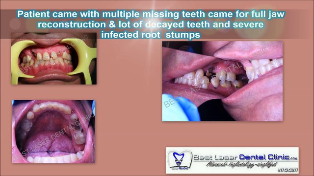 FULL ARCH DENTAL IMPLANTS COST IN INDIA