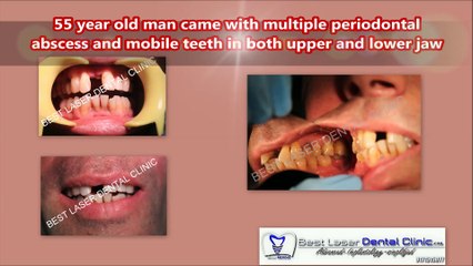 Full Arch Metal Ceramic bridge For severe Periodontitis Condition