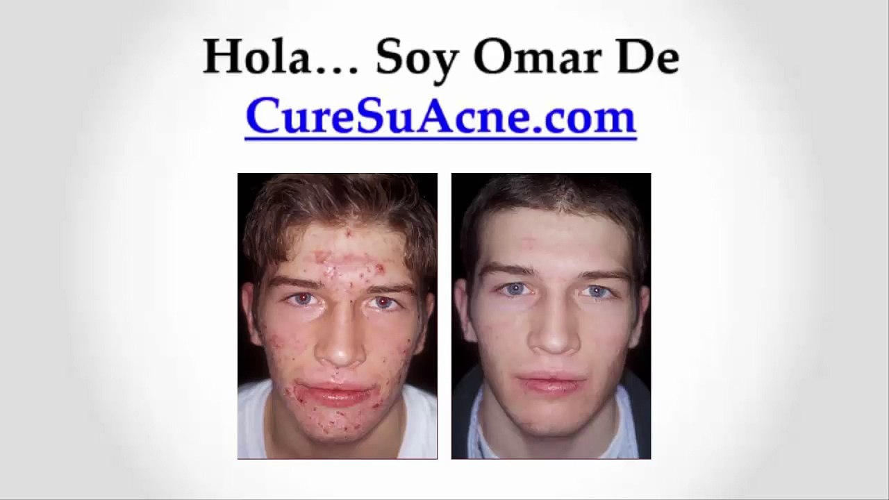 Como acabar con el acné definitivamente "Mejores Tips"