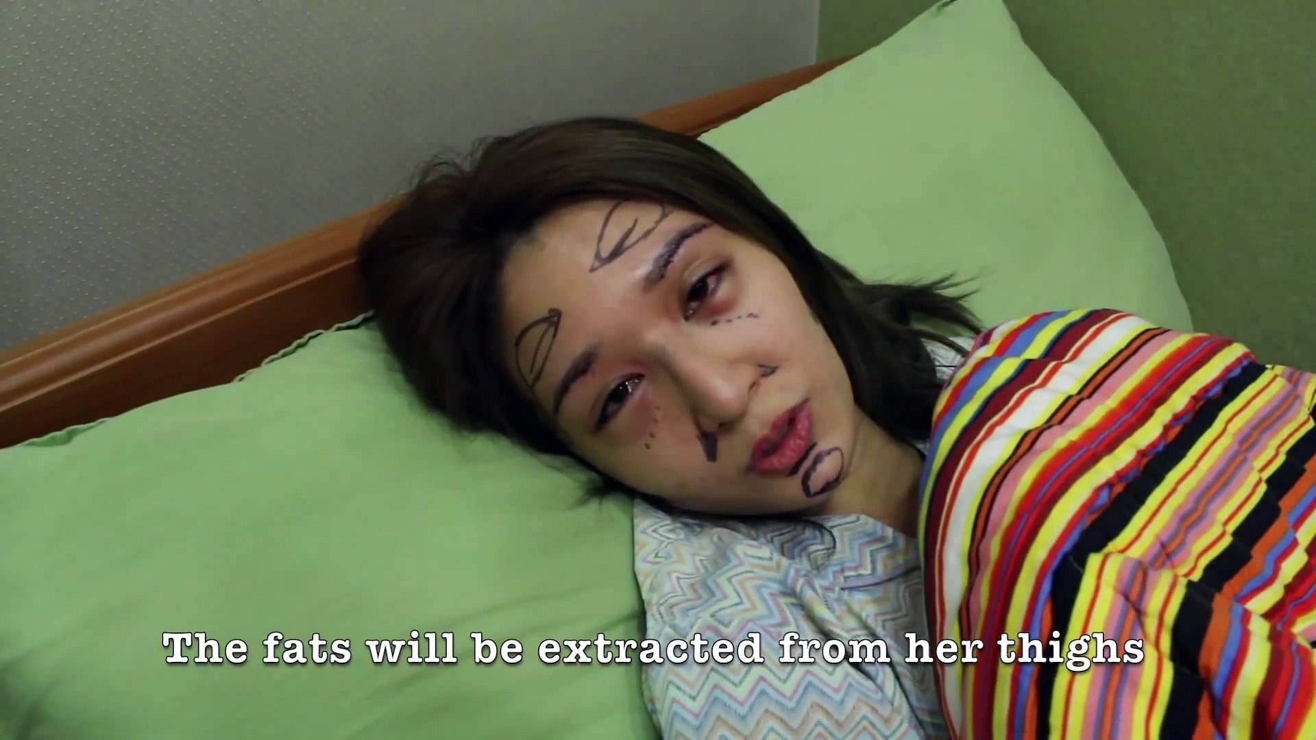 ⁣[JW Plastic Surgery Korea] Agri Velt, Reiee Kok & Agnes' journey of plastic surgery Part.2
