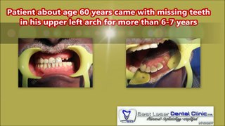 UPPER ARCH DENTAL IMPLANTS COST IN INDIA