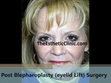 Blepharoplasty | Best Upper & Lower Eyelid Lift Surgery in Mumbai India - Dr. Debraj Shome