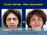 Botox Treatment | Botox Injection (Juvederm, Restylane) in Mumbai, India by Dr. Debraj Shome