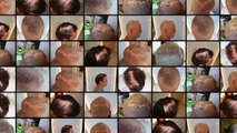 Hair Transplantation - Restoration at PHAEYDE Clinic - PHAEYDE Clinic