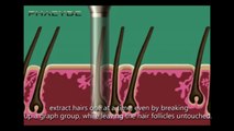 Hair Implant with the S.H.E. Hair Implant Method - PHAEYDE Clinic (1/3)