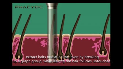 Hair Implant with the S.H.E. Hair Implant Method - PHAEYDE Clinic (1/3)