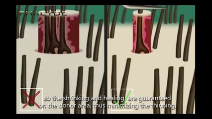 Hair Implant with the S.H.E. Hair Implant Method - PHAEYDE Clinic (2/3)