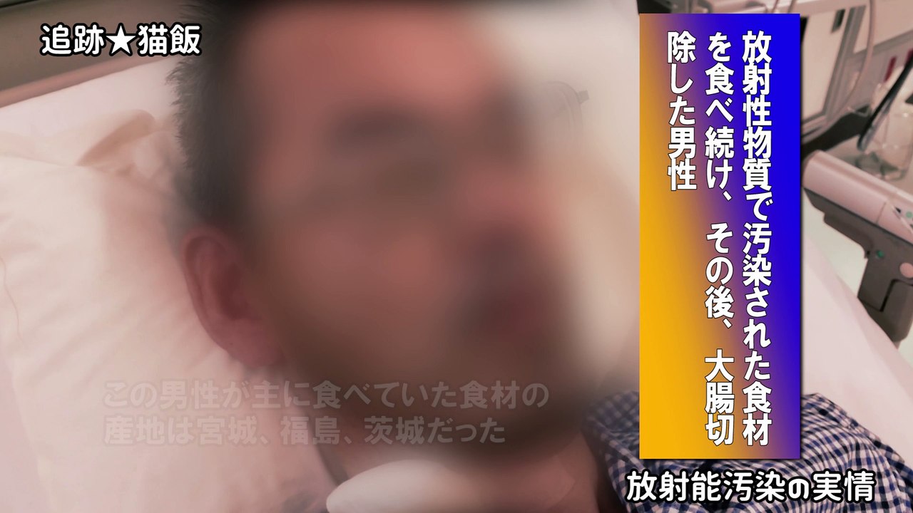 大腸切除