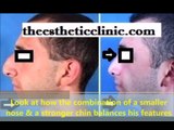 Chin Implant | Chin Augmentation | Cheek Malar Enhancement in Mumbai India - Dr. Debraj Shome