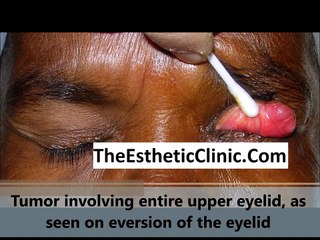 Eyelid Cancer | Sebaceous Gland Carcinoma | Cutler Beard Eyelid Flap Surgery - Dr. Debraj Shome