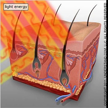 Laser Hair Removal -Get rid of unwanted hair removal