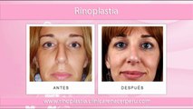 Rinoplastia - Antes y Despues - Clinica Renacer Perú