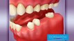 Dental Bridge explained - Lookswoow Dental Clinic in Dubai