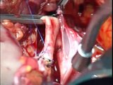 Trapianto di rene in chirurgia open - kidney transplant in open surgery-Dott. Mauro Frongia-