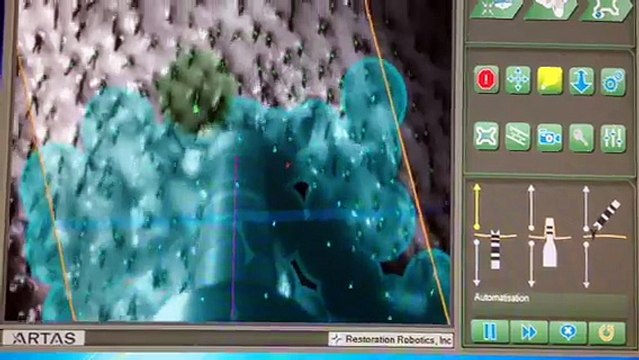 Démonstration implants capillaire avec le robot ARTAS par The Clinic Paris