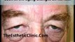 FaceLift | Mid Face Lifting Surgery | Mini FaceLifting Treatment | Blepharoplasty - Dr. Debraj Shome