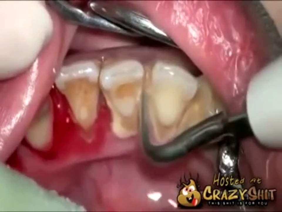 Détartrage de dents après 10 ans sans brossage de dent! Violent...