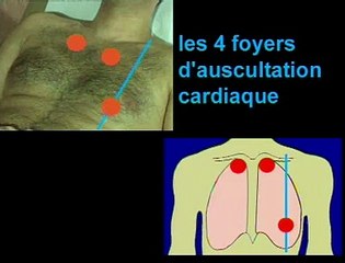 LES 4 FOYERS D'AUSCULTATION CARDIAQUE