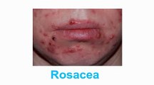 Rosacea - Stop Rosacea Nu