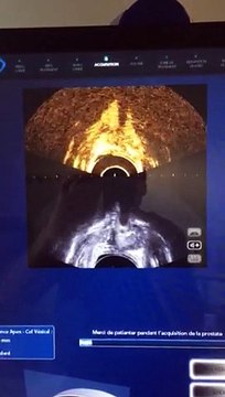 echographie de contraste apres traitement par ultrasons ( HIFU) pour un cancer localisé de la porstate