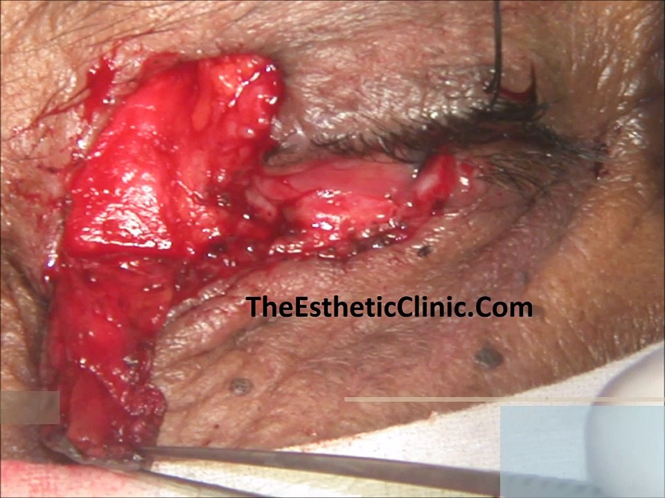 Skin Cancer Treatment | Basal Cell Carcinoma Eyelid | Mohs Surgery Mumbai, India - Dr. Debraj Shome