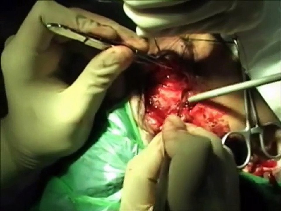 Proptosis Surgery | Big Eyes | Cavernous Hemangioma | Orbital Lymphoma | Oculoplastic Surgery India