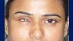 Prosthetic Eye Post Enucleation Evisceration Eye Surgery in Mumbai, India - Dr. Debraj Shome