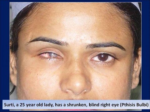 Prosthetic Eye Post Enucleation Evisceration Eye Surgery in Mumbai, India - Dr. Debraj Shome