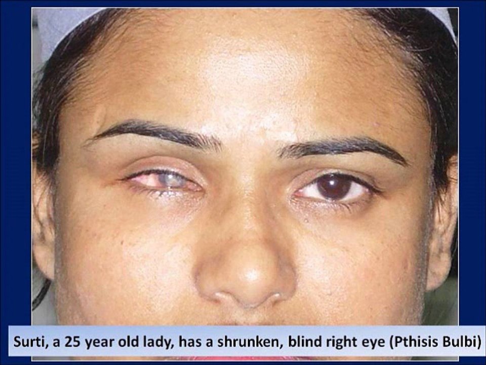 Prosthetic Eye Post Enucleation Evisceration Eye Surgery in Mumbai, India - Dr. Debraj Shome